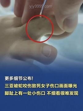 三亚被咬女子神经毒蛇咬伤案例研究